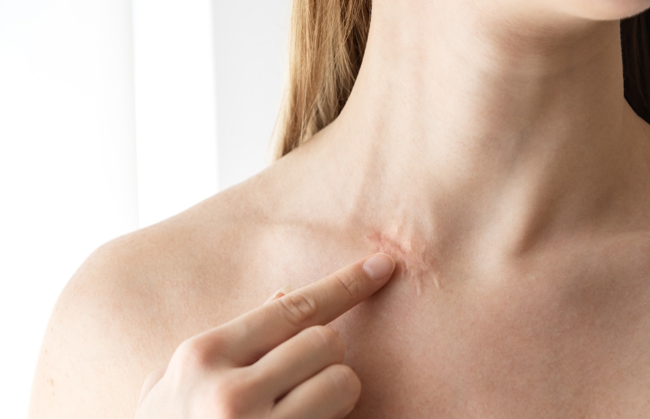 Surgery scar on woman neck