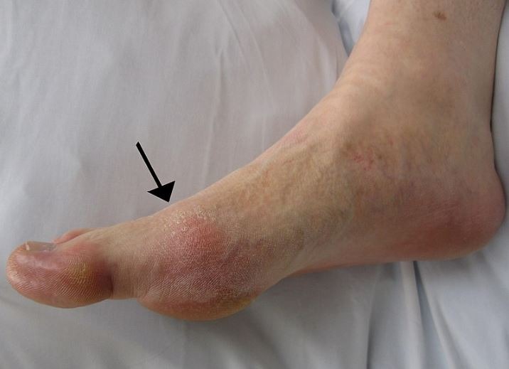 gout presenting in the metatarsal-phalangeal joint of the big toe