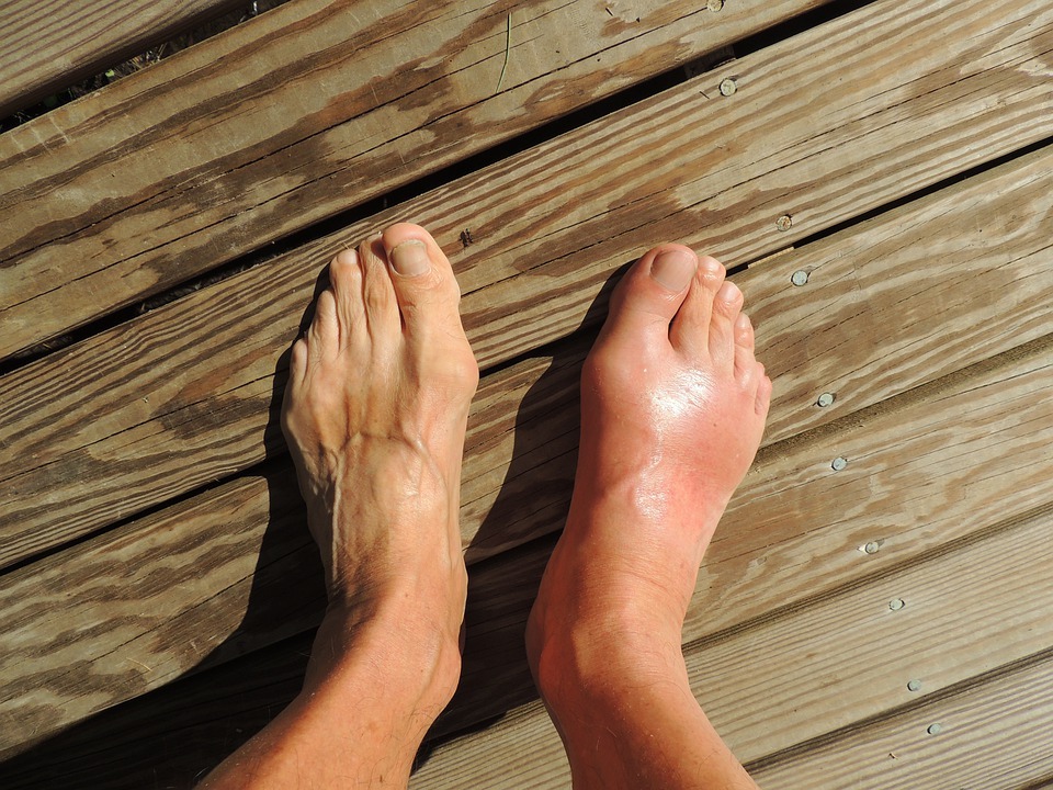 A feet with gout pain
