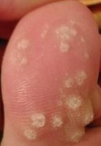 Warts on Toes