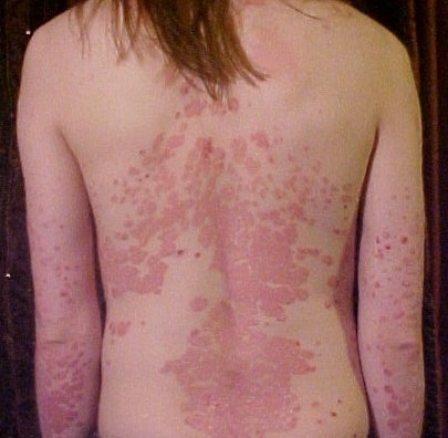 Back and arms of a person with psoriasis