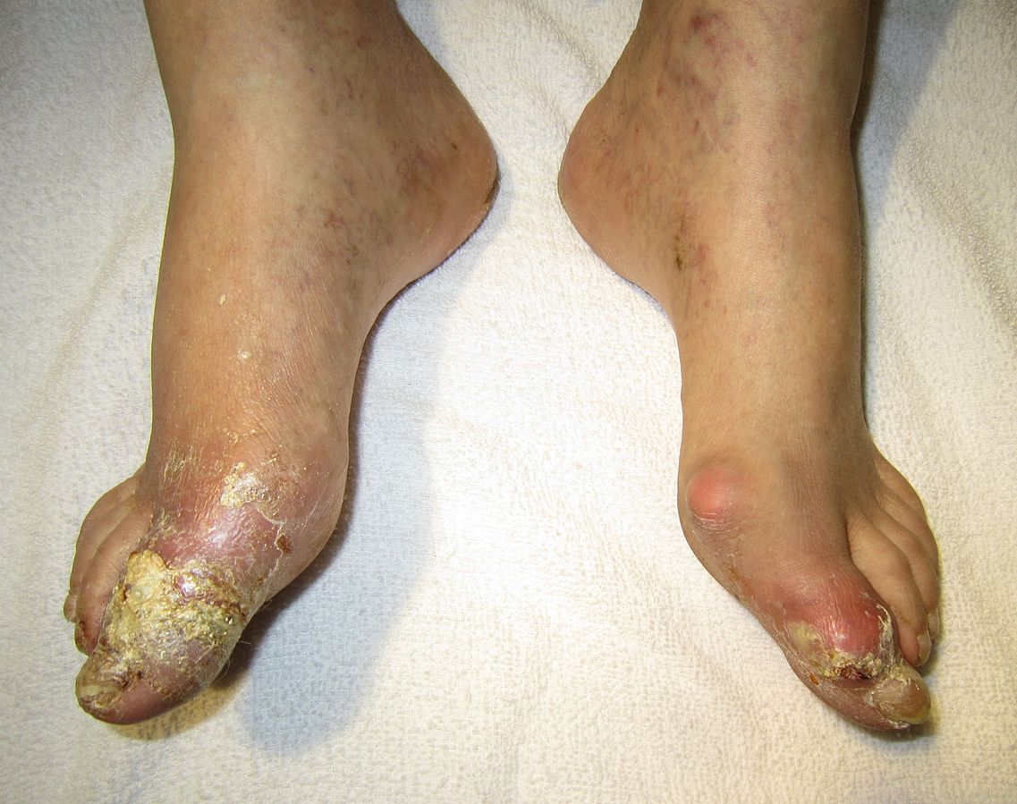 Gout complicated by ruptured tophi, the exudate of which tested positive for uric acid crystals