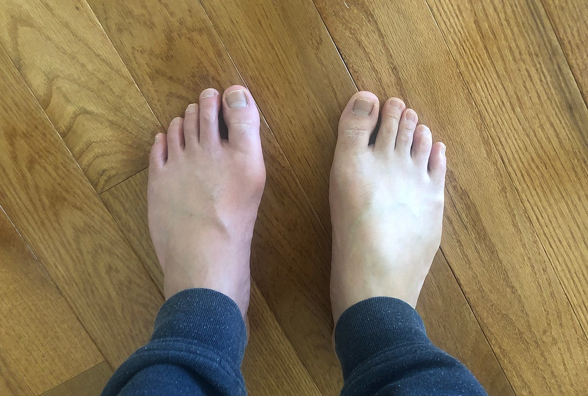 Gout in the big toe of left foot, compared to the healthy right foot