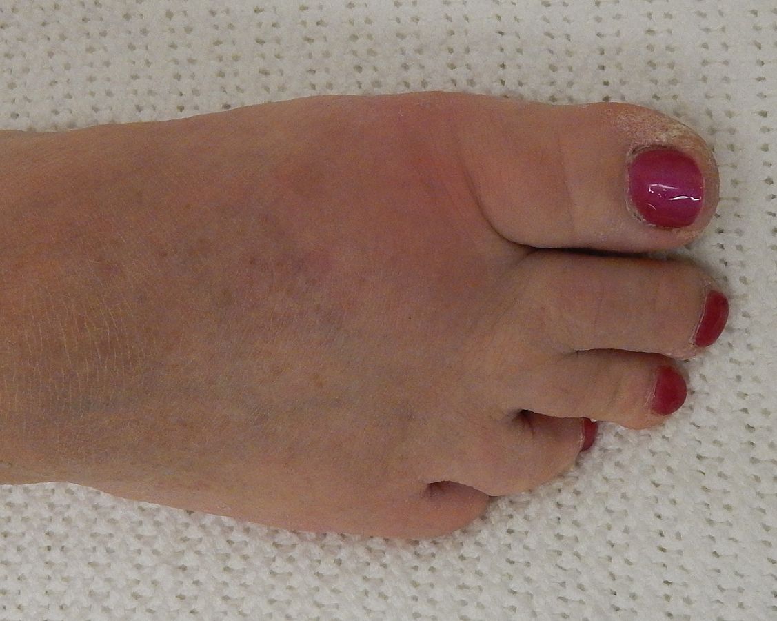 Gout in the joint of the big toe