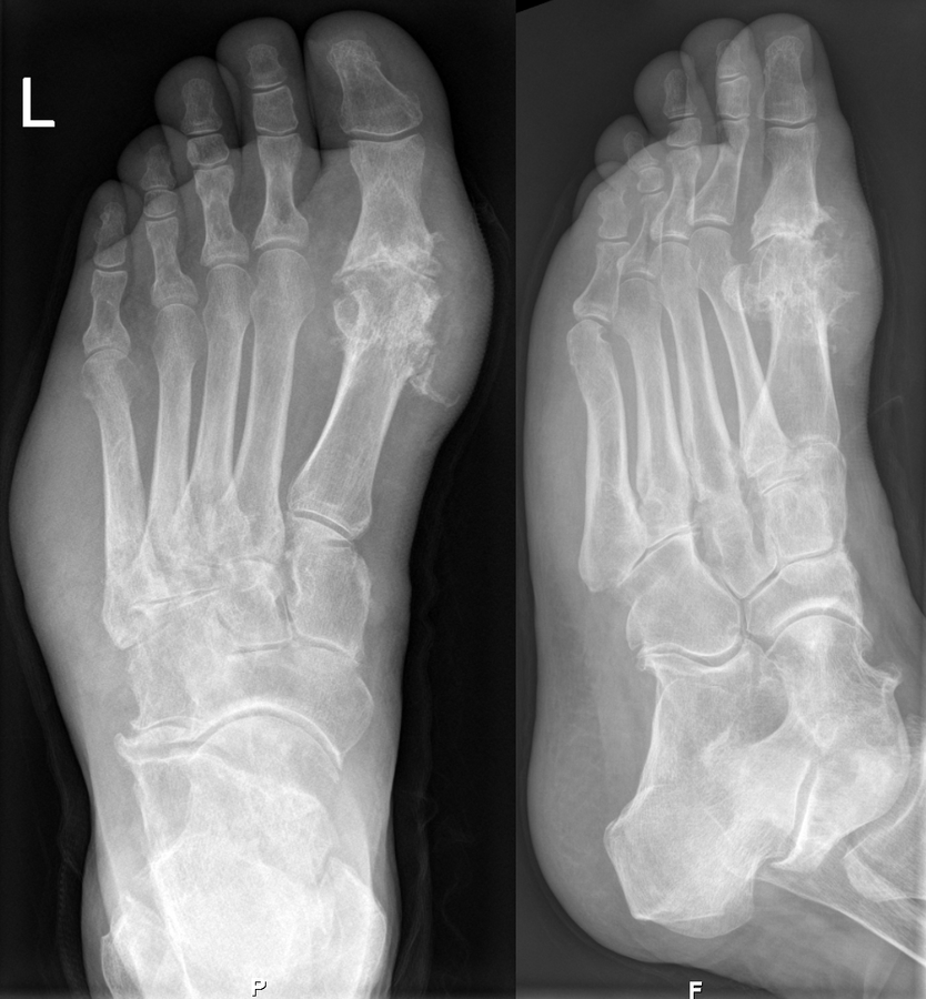 Gout on X-rays of a left foot in the metatarsal-phalangeal joint of the big toe. Note also the soft tissue swelling at the lateral border of the foot.