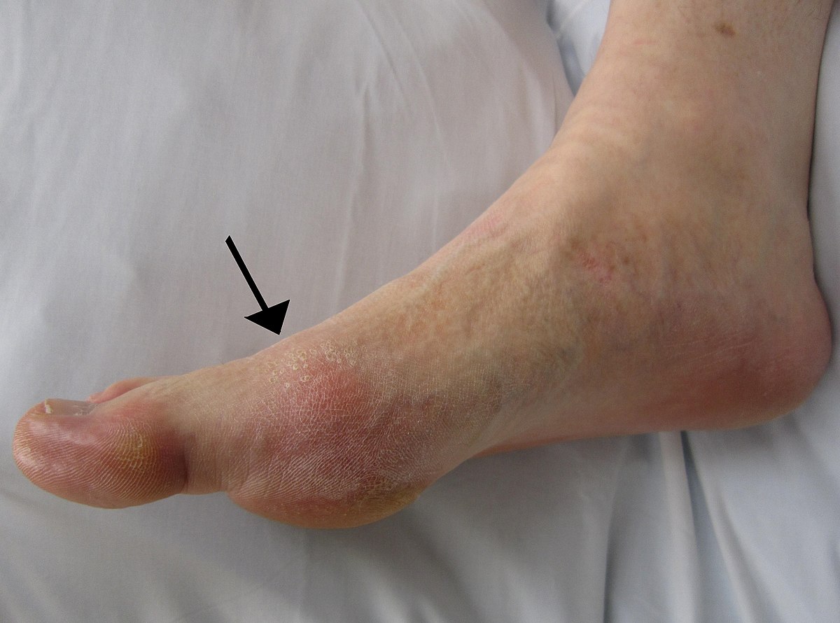 Gout presenting as slight redness in the metatarsophalangeal joint of the big toe