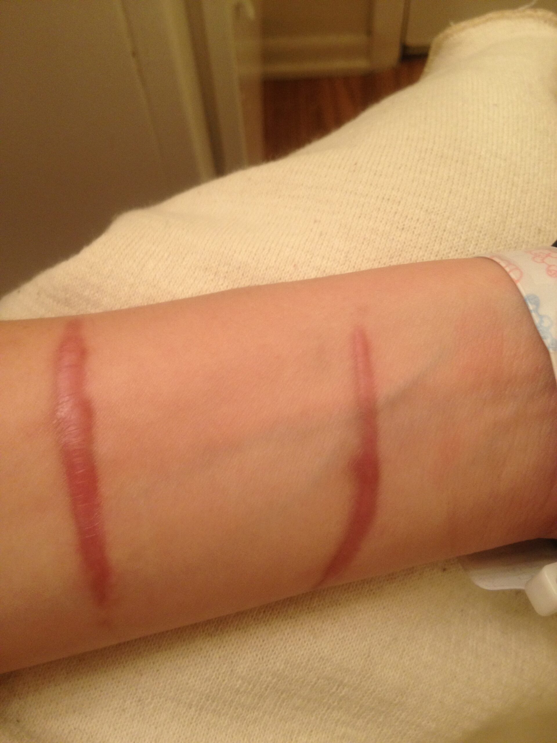 Hypertrophic scar (4 months after incident)