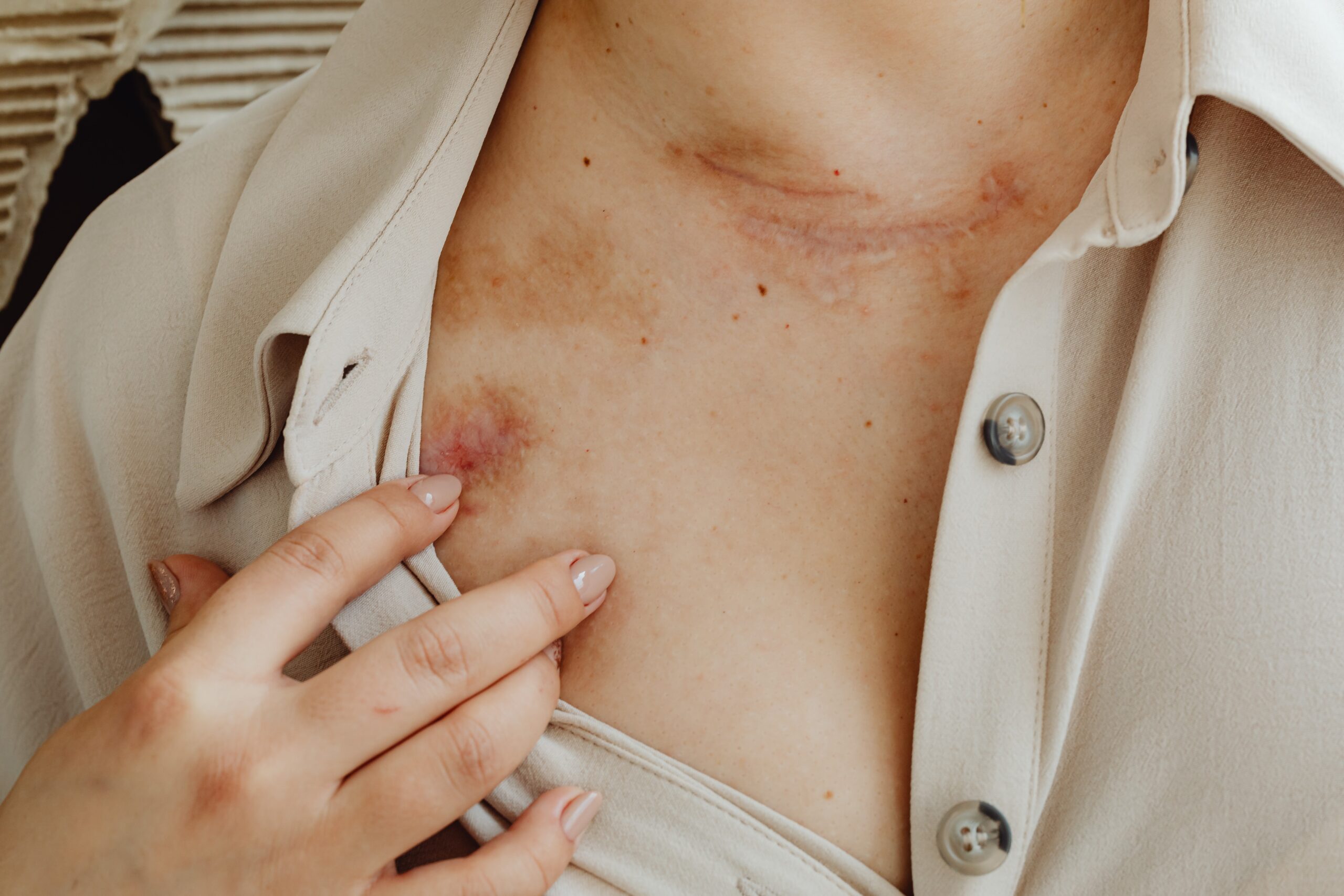 woman with scars on her skin